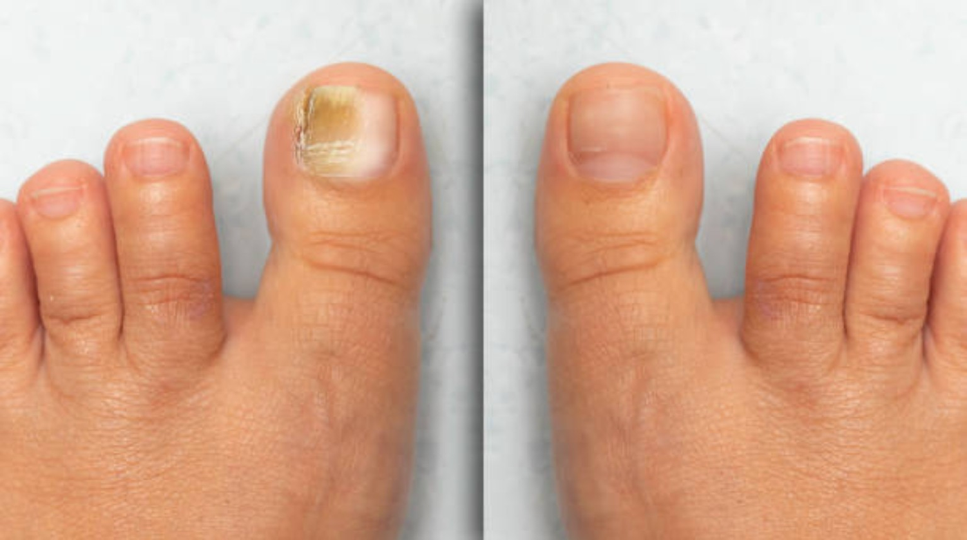 Fungal Nails wellness guide