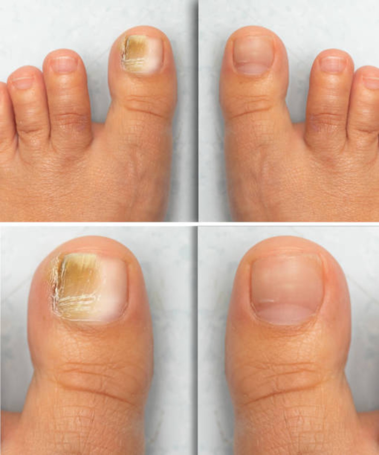 Fungal Nails wellness guide