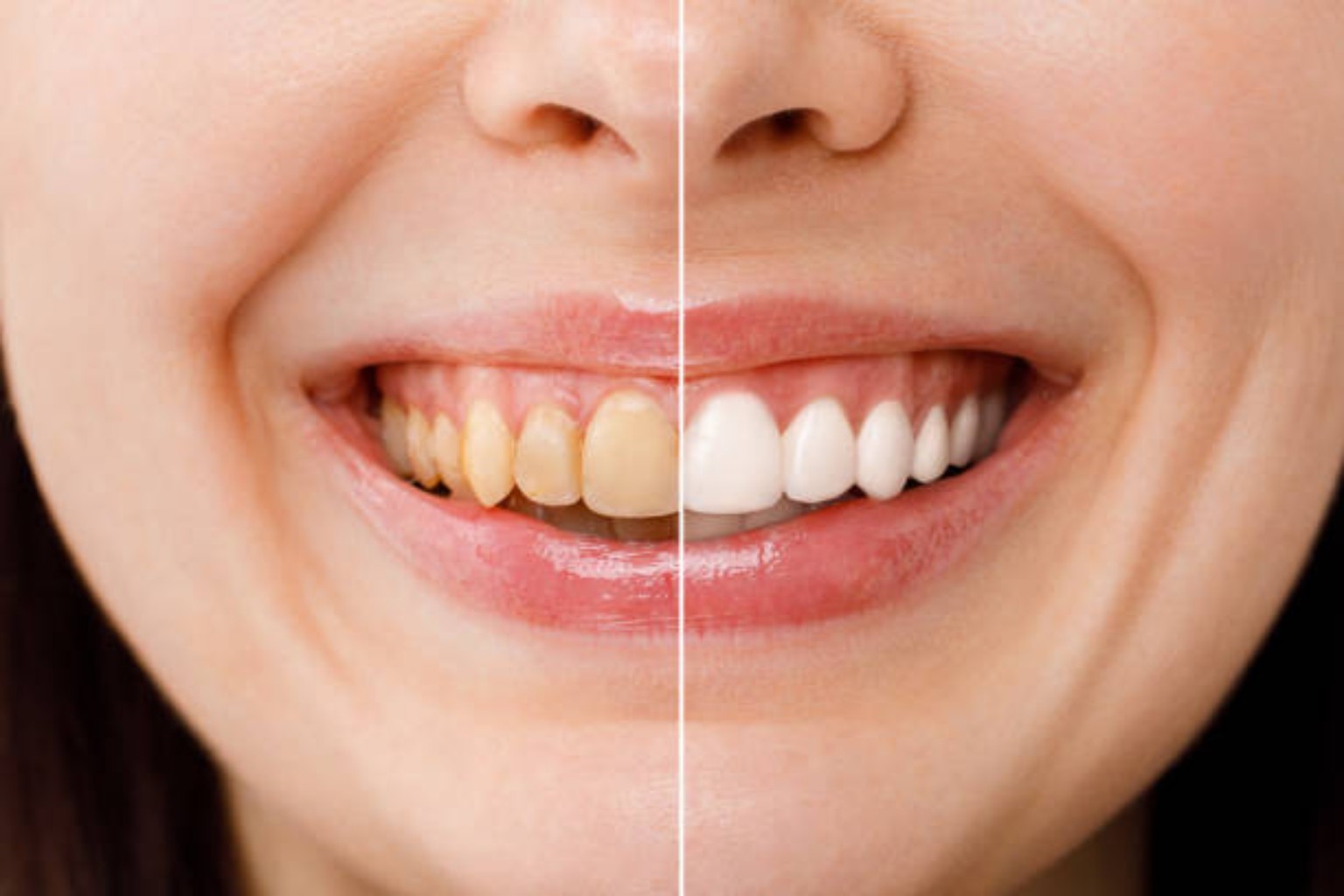 Teeth Whitening wellness guide